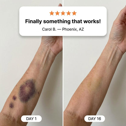 💥100K+ SOLD💕- Wuaiee® Bruise Repair & Skin-Strengthening Cream